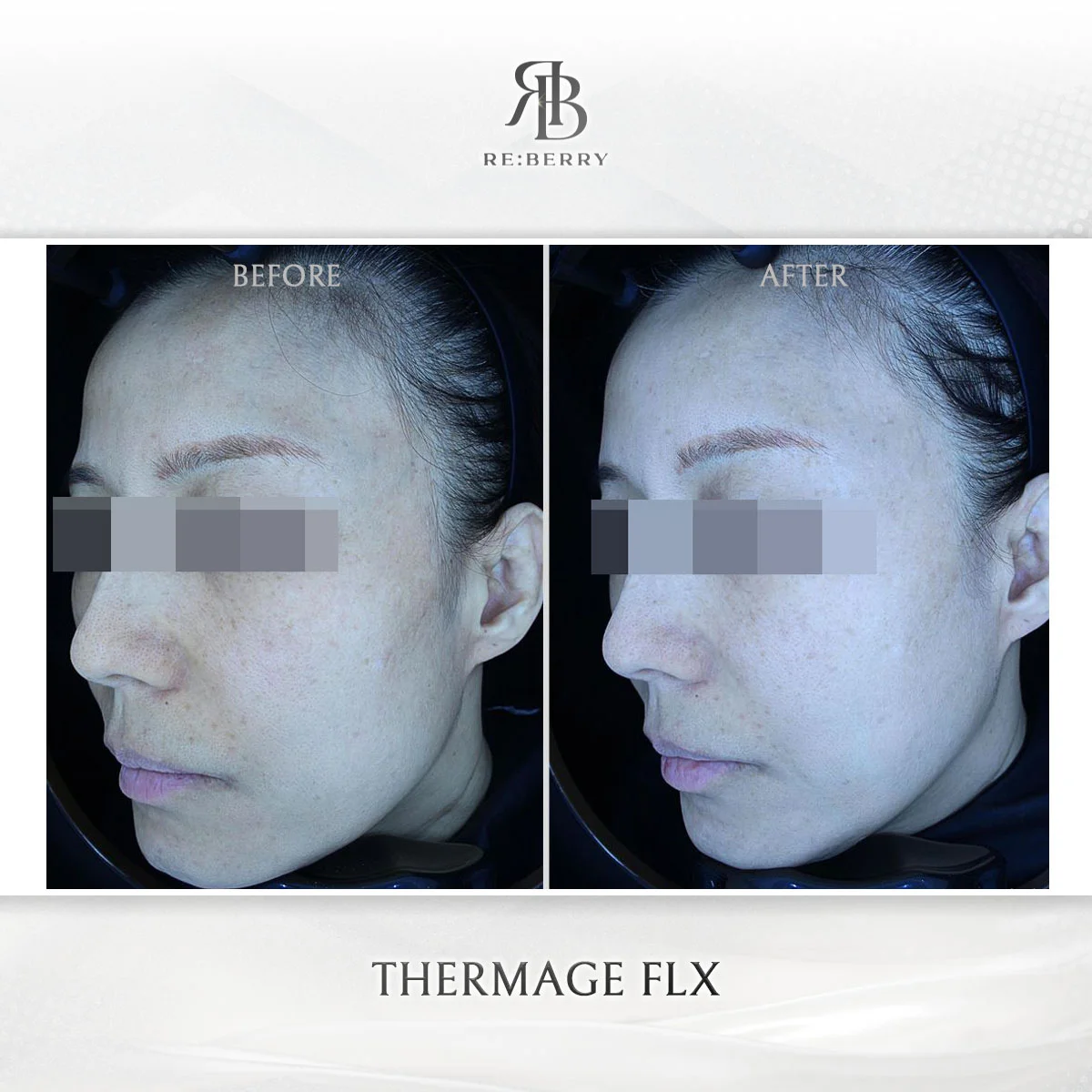 Skin tightening before and after result
